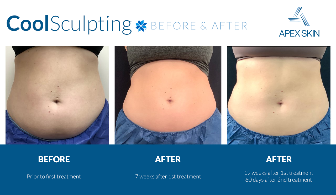 Coolsculpting Cryolipolysis Non Invasive Fat Freezing Treatment