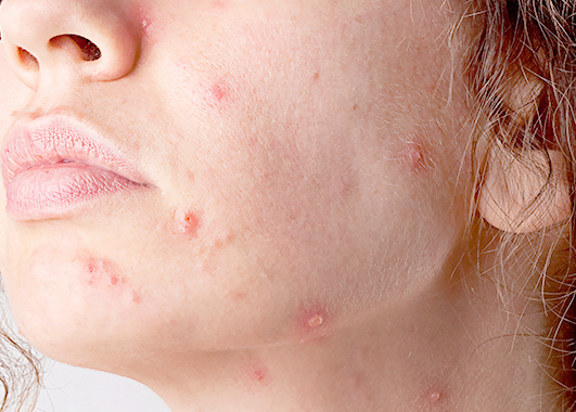 Actinic Keratosis