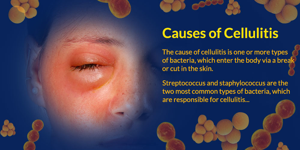 Cellulitis (Infections) - Apex Dermatology & Skin Surgery