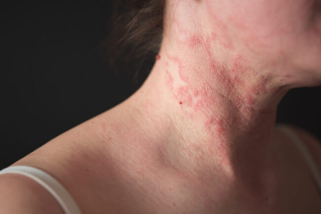 the girl has dermatitis on the neck on a black background Eczema
