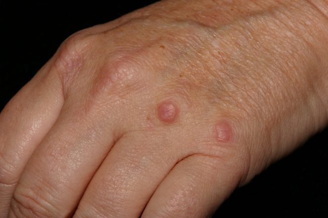 Granuloma