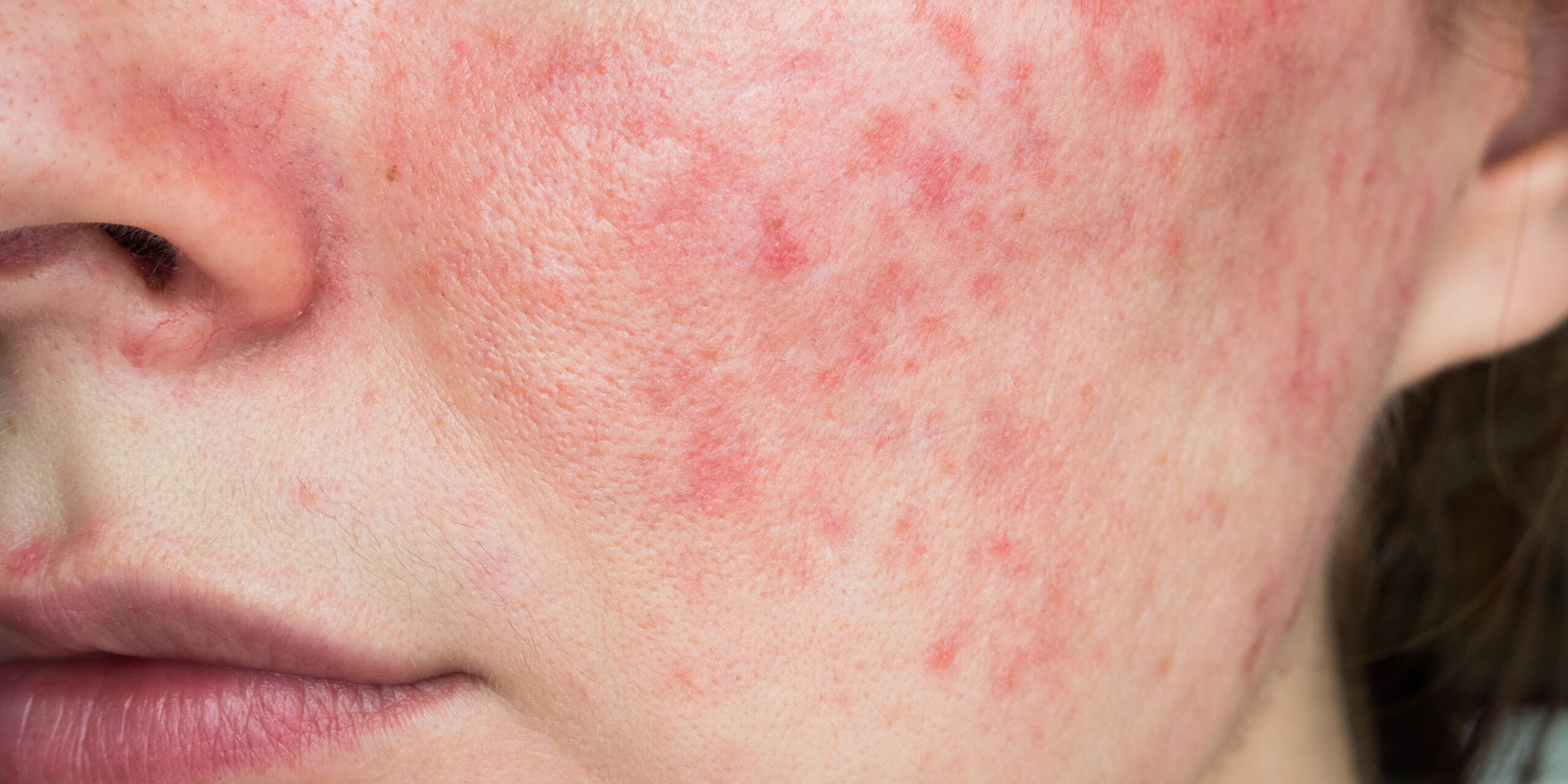 Rosacea