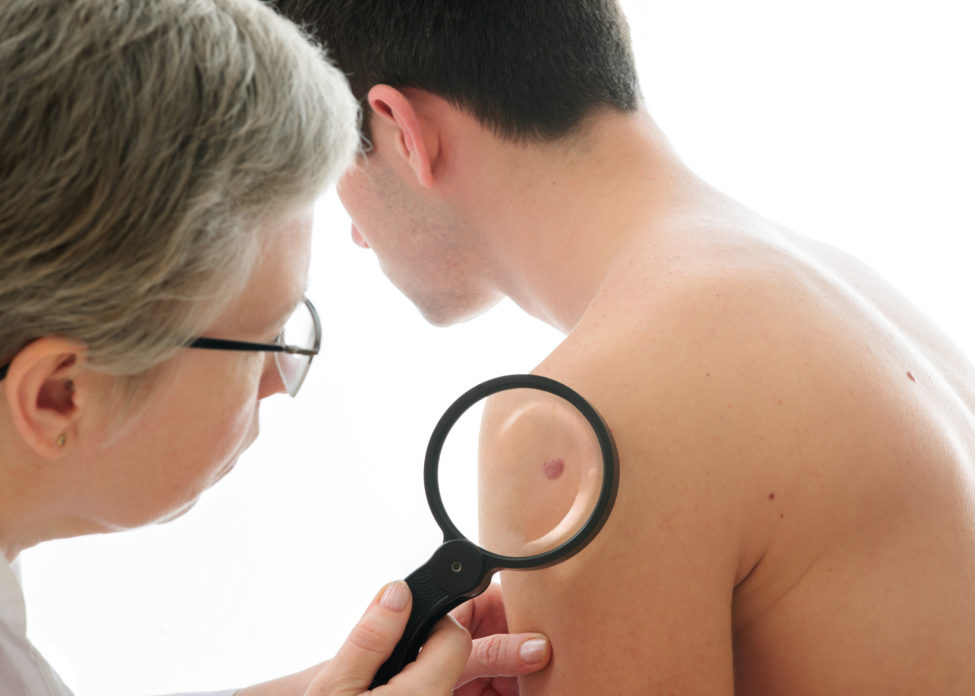 Cancerous moles