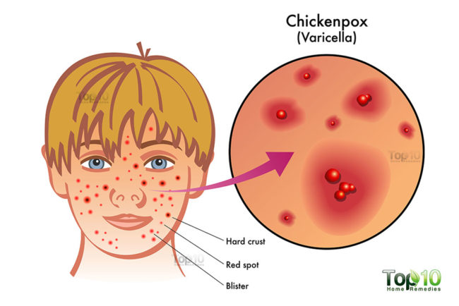 Chicken Pox