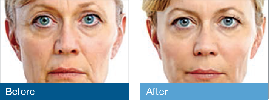 Injectable Fillers Before & After