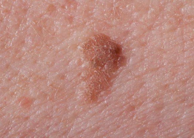 Seborrheic Keratosis