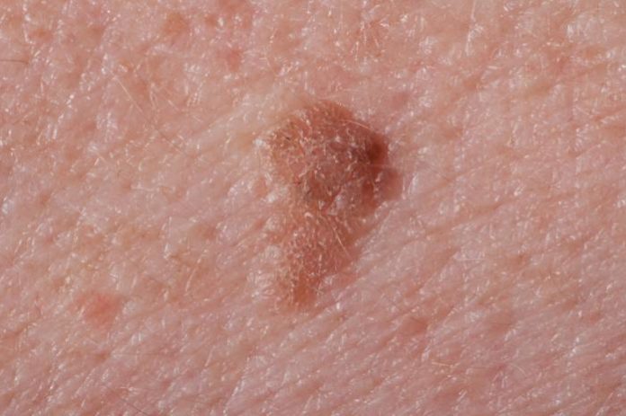 Seborrheic Keratosis