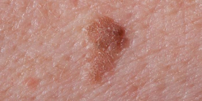 Seborrheic Keratosis