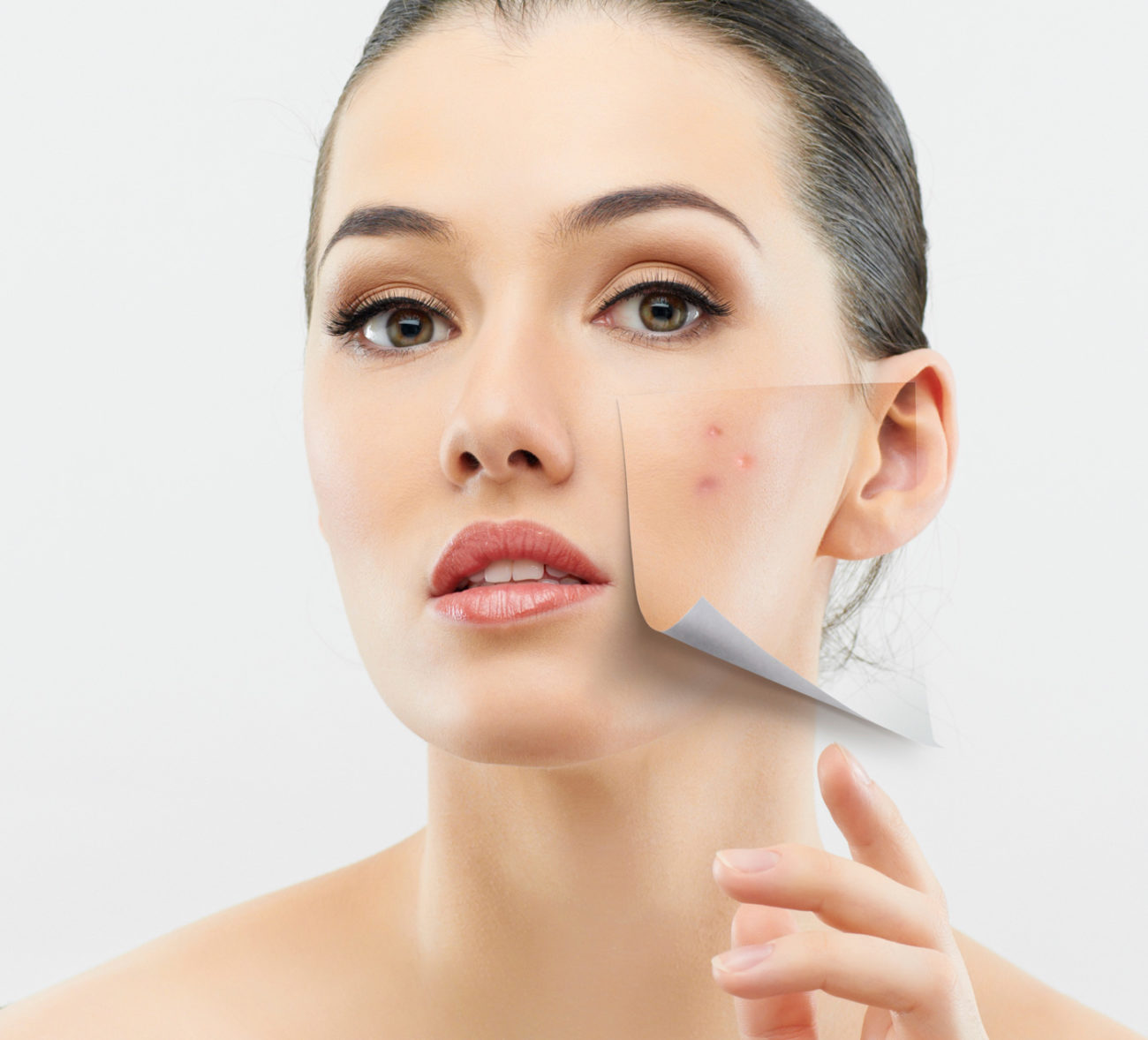 home-remedies-to-remove-deep-acne-scars-bellatory