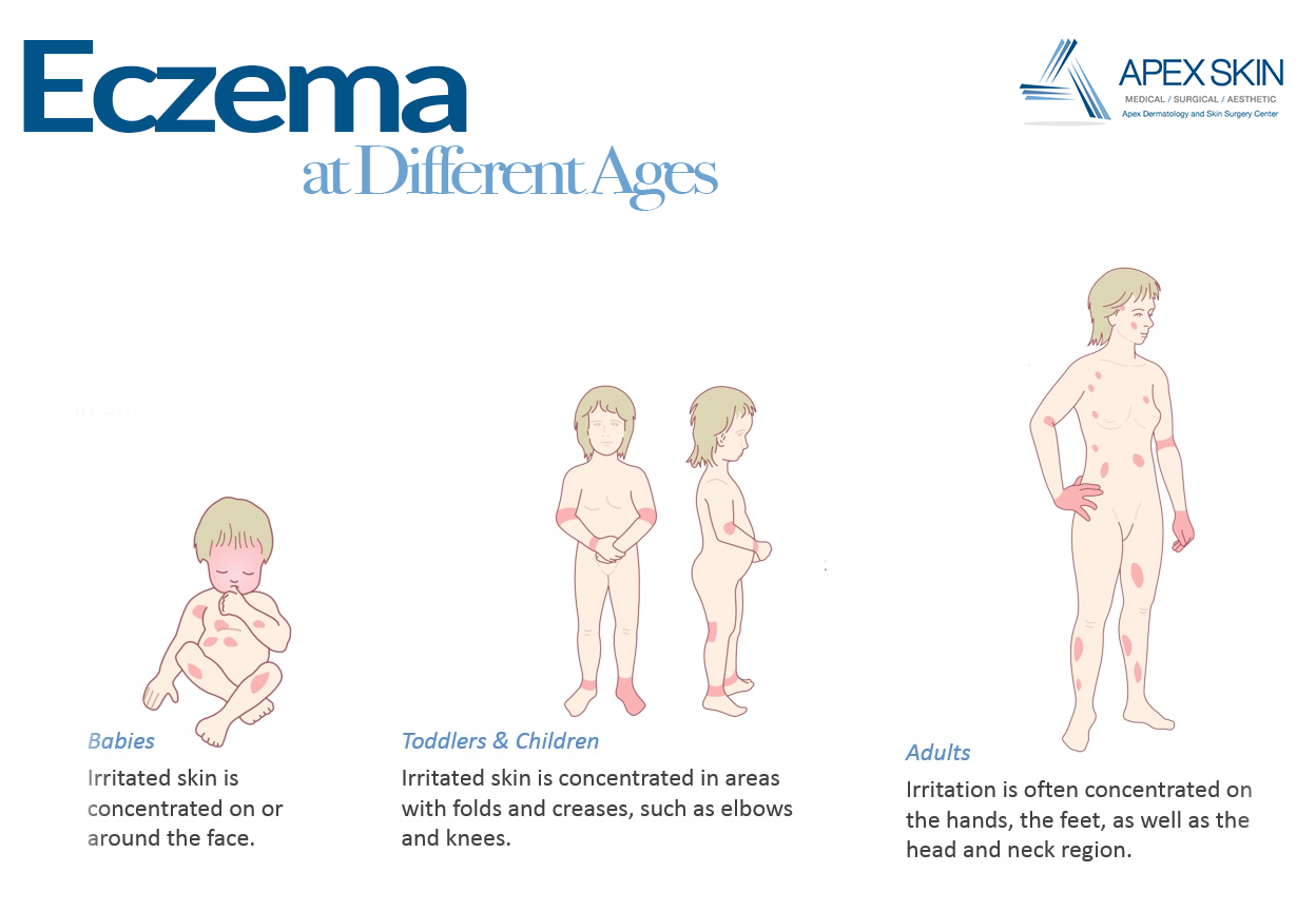 eczema at different ages