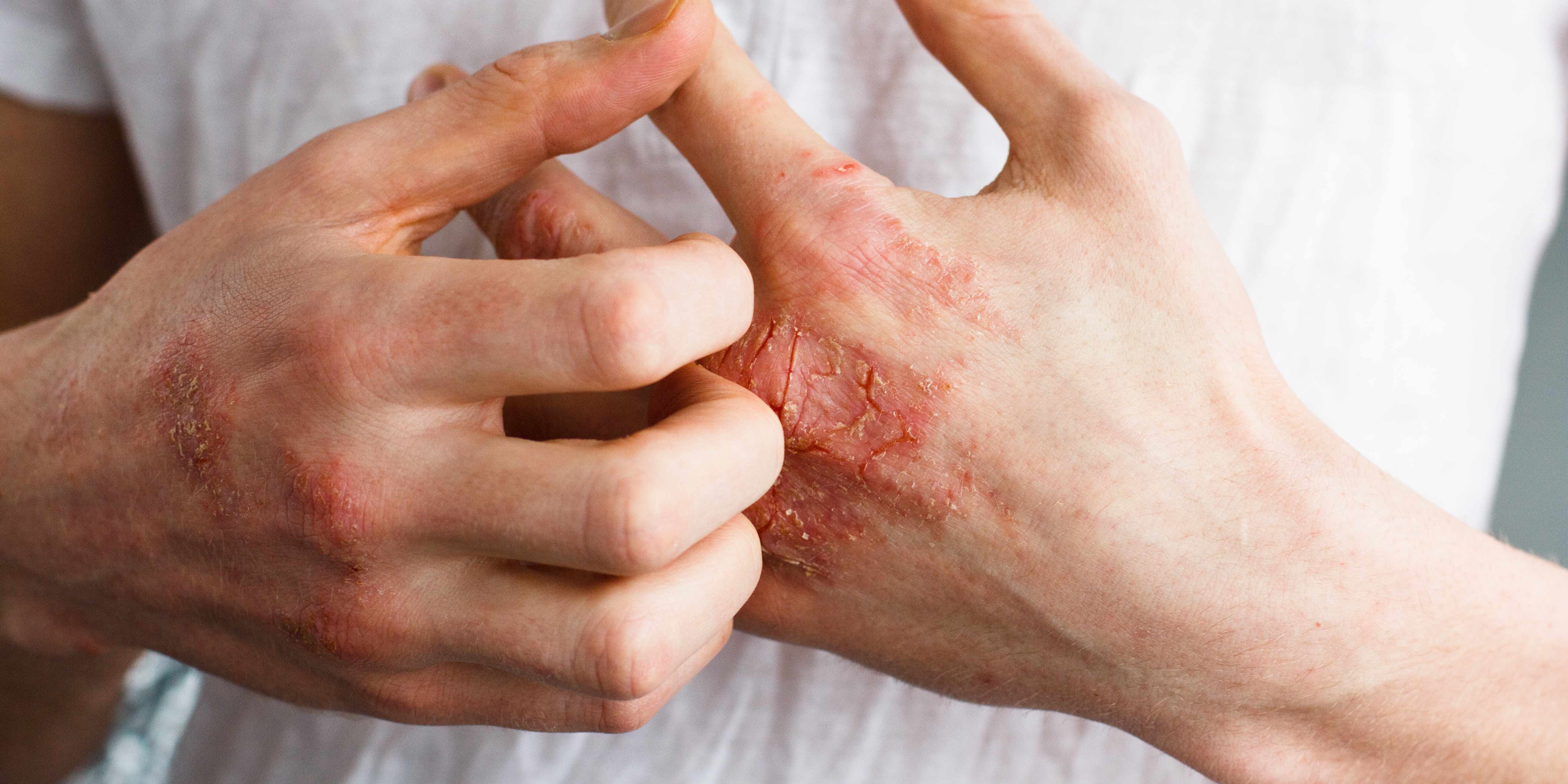 What is Eczema and How Can it Affect You Apex Dermatology & Skin