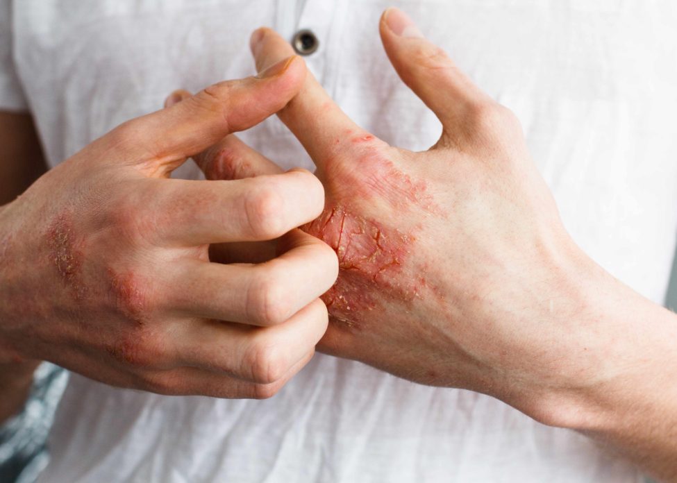 eczema eczema