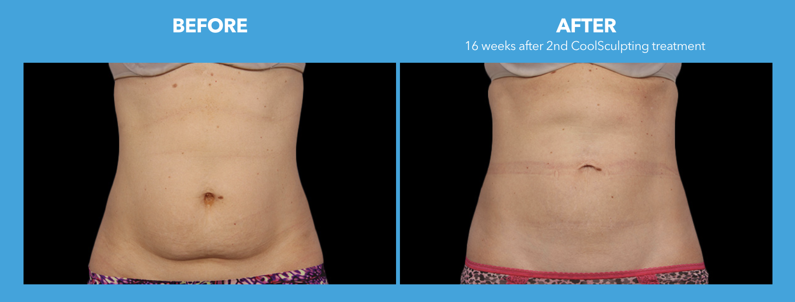 Coolsculpting Treatment Belly - Before and After