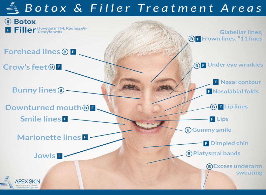 botox and fillers questions and answers