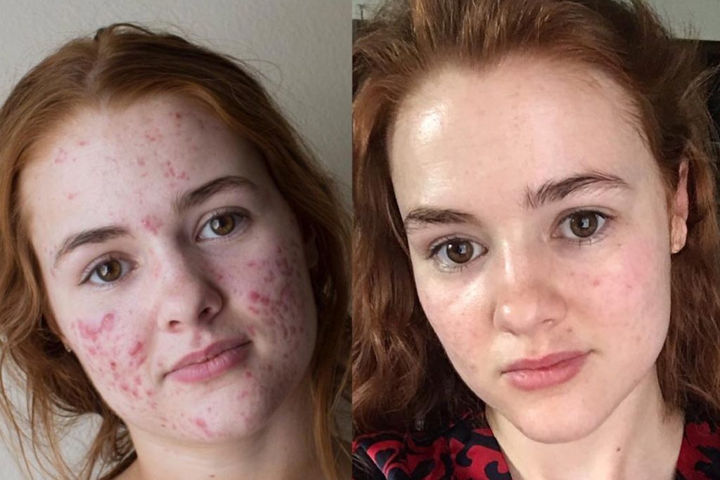 Accutane A Dermatologist Tells All Apex Skin
