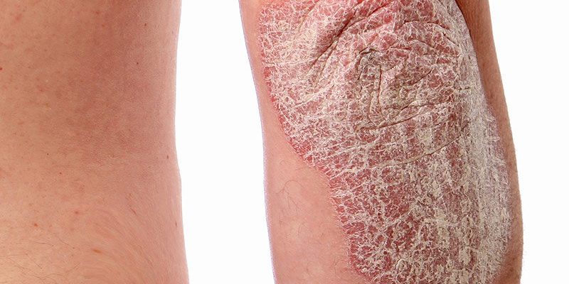 psoriasis psoriasis