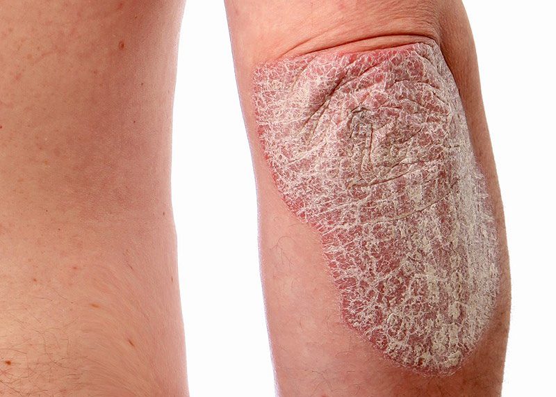 psoriasis psoriasis
