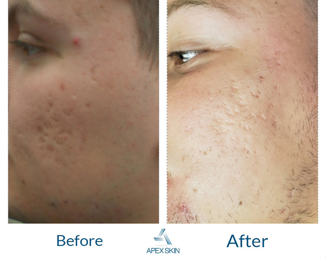 microneedling before and after