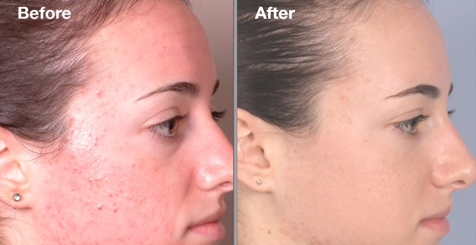 dermalinfusion before and after