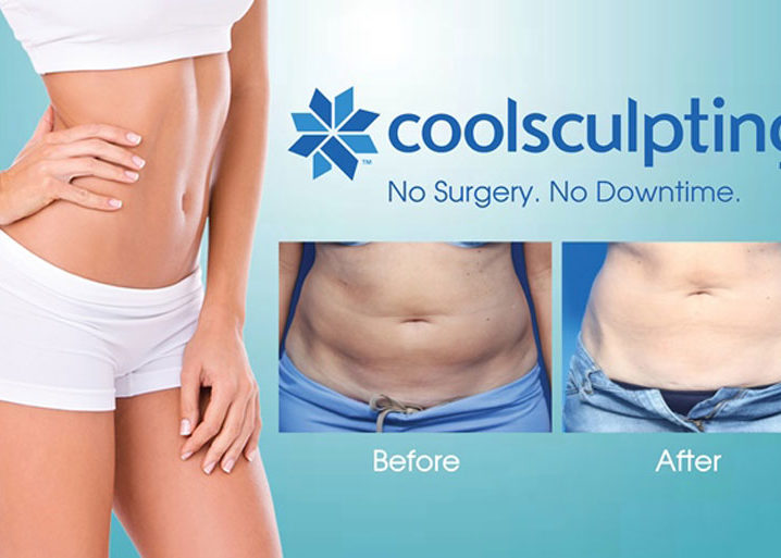Coolsculpting Results – Before and After Coolsculpting Results - Before and After