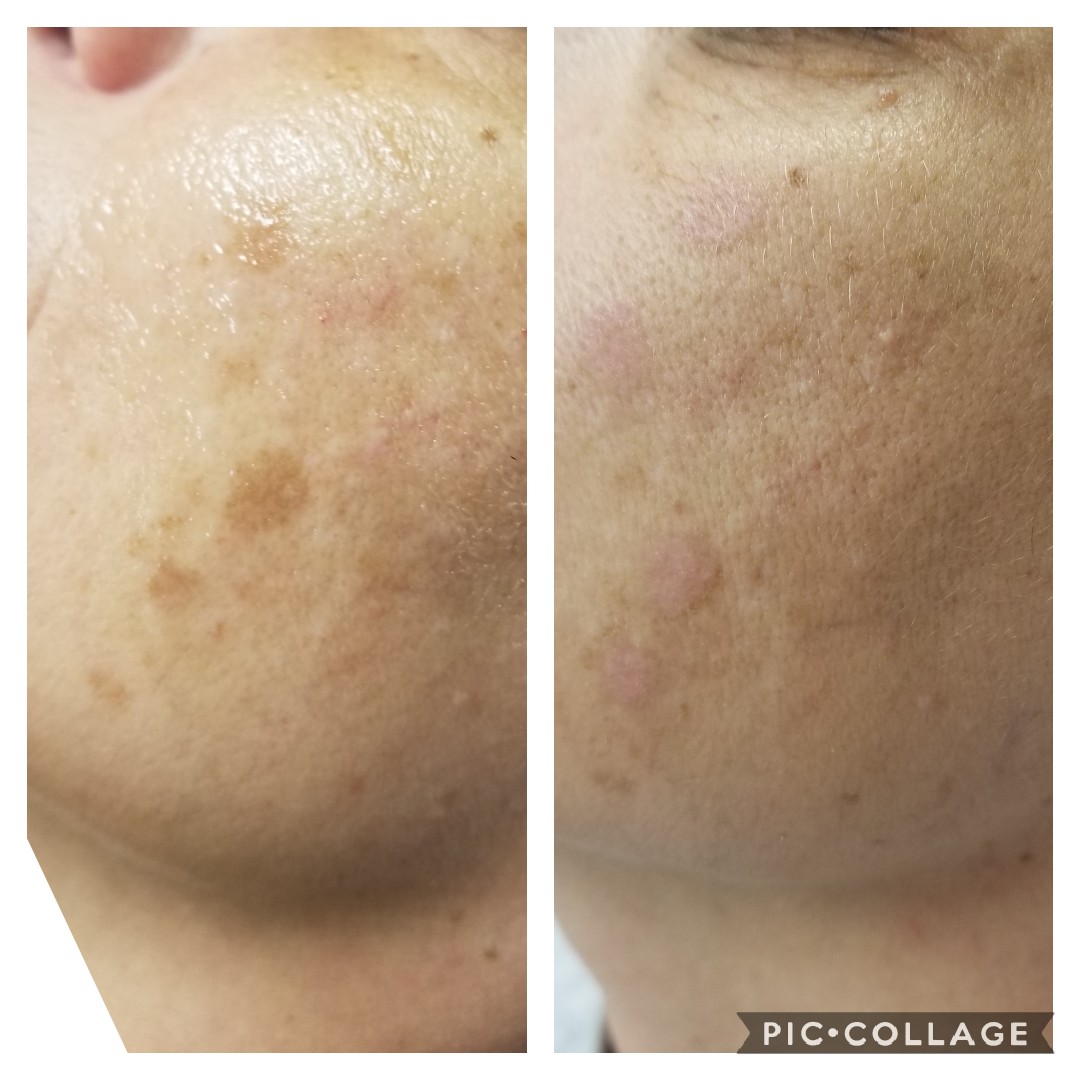 CryoClear Hyperpigmentation Treatment
