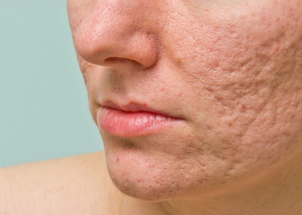 how to get rid of acne scars how to get rid of acne scars