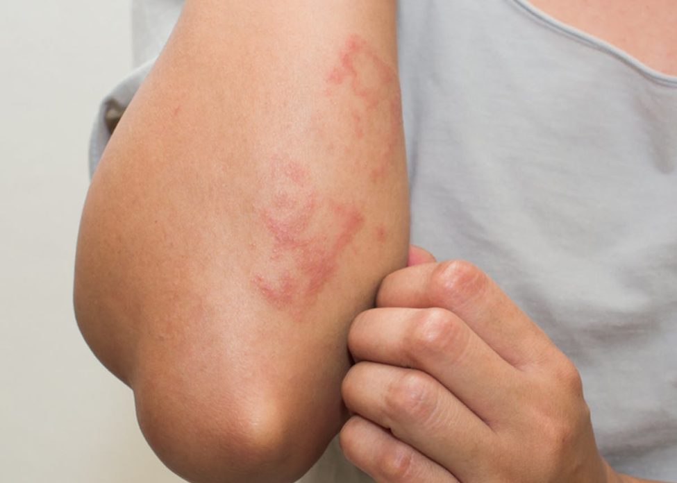 covid skin rashes covid skin rashes