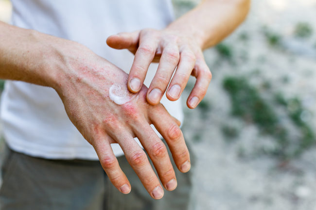 hand dermatitis hand dermatitis