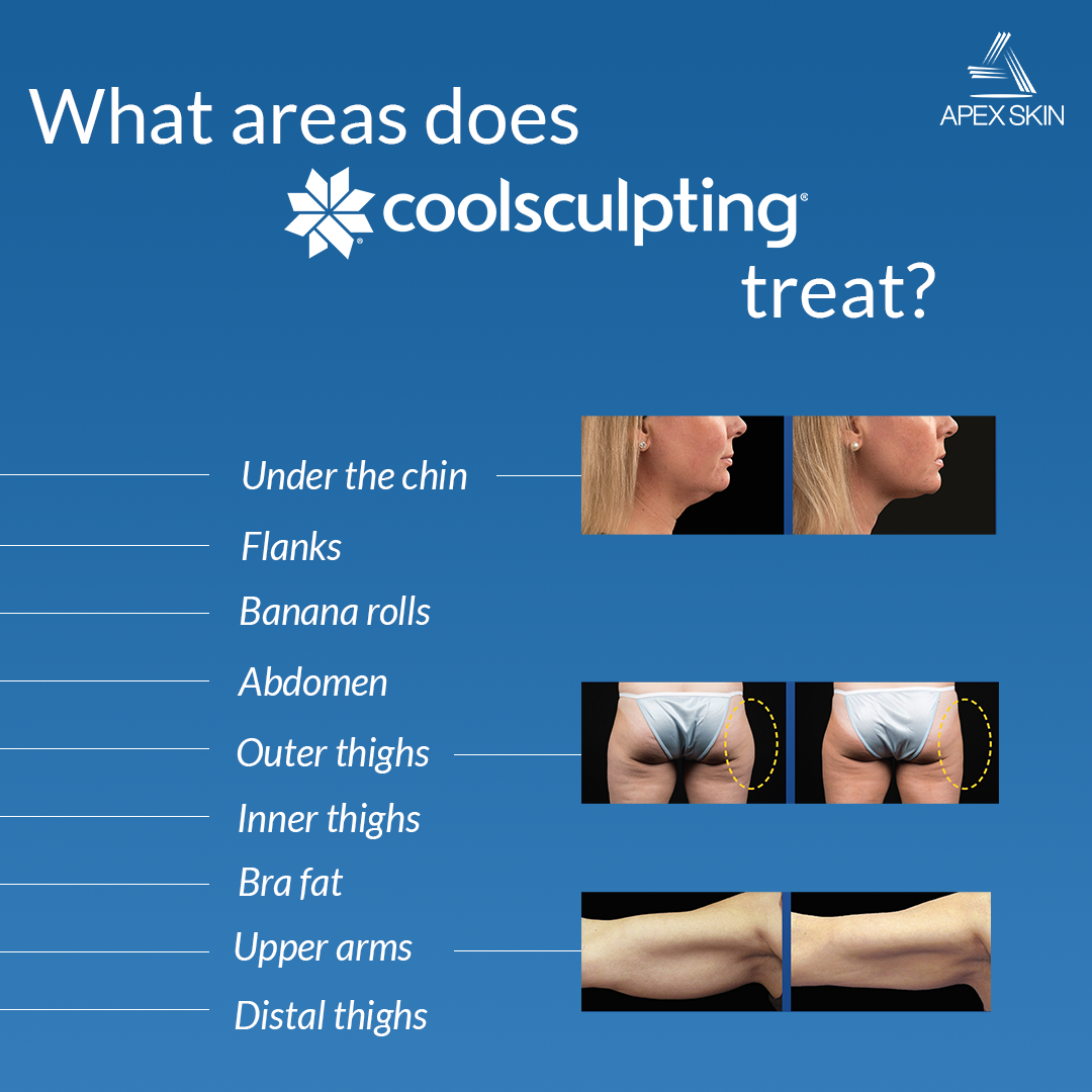 coolsculpting treatment areas