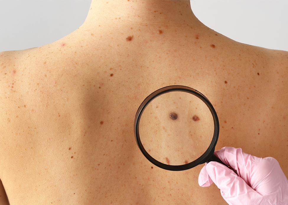 remove skin cancer