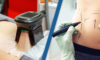 coolsculpting vs liposuction