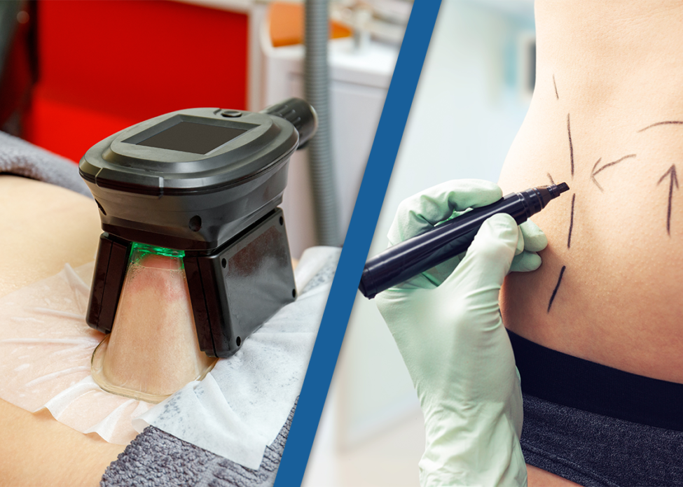coolsculpting vs liposuction