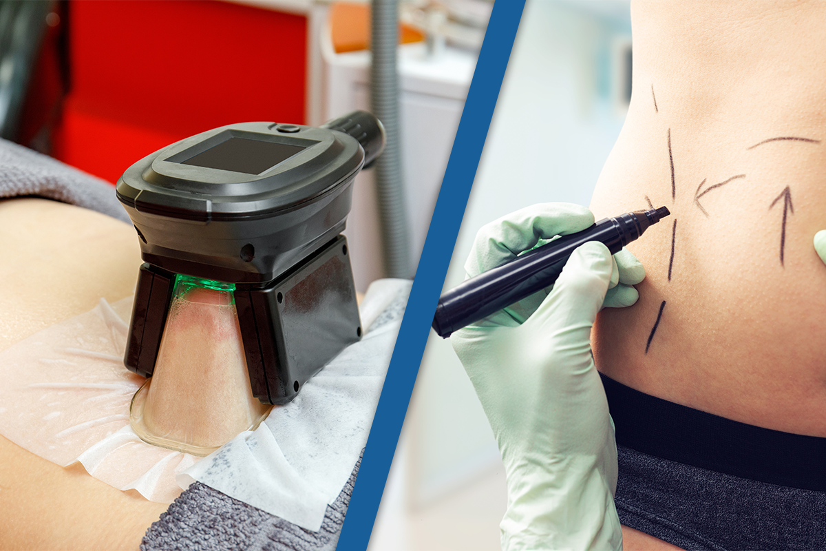 CoolSculpting VS Other Fat Removal Methods: Heat-Based