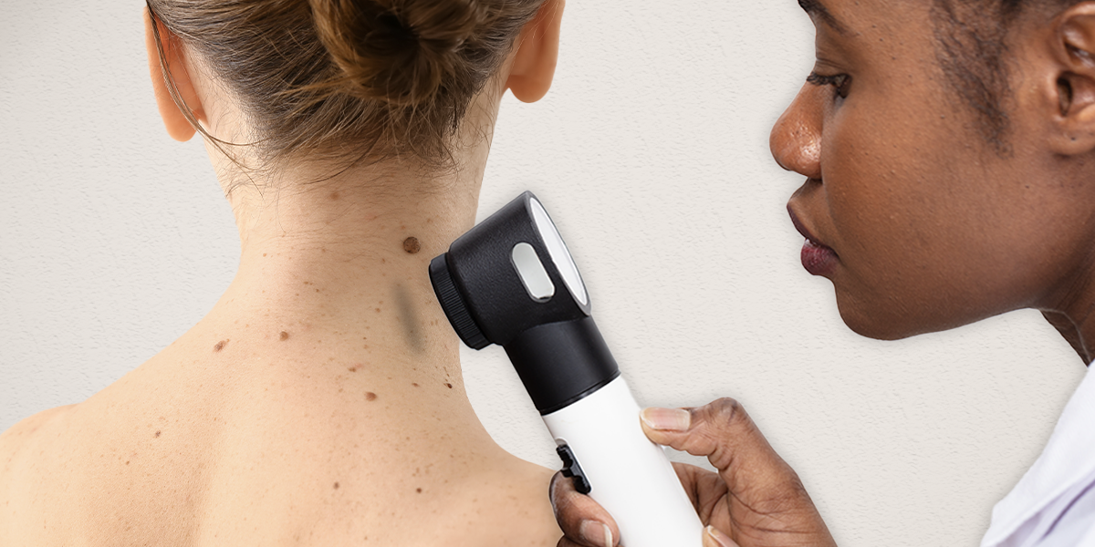 basal cell carcinoma basal cell carcinoma