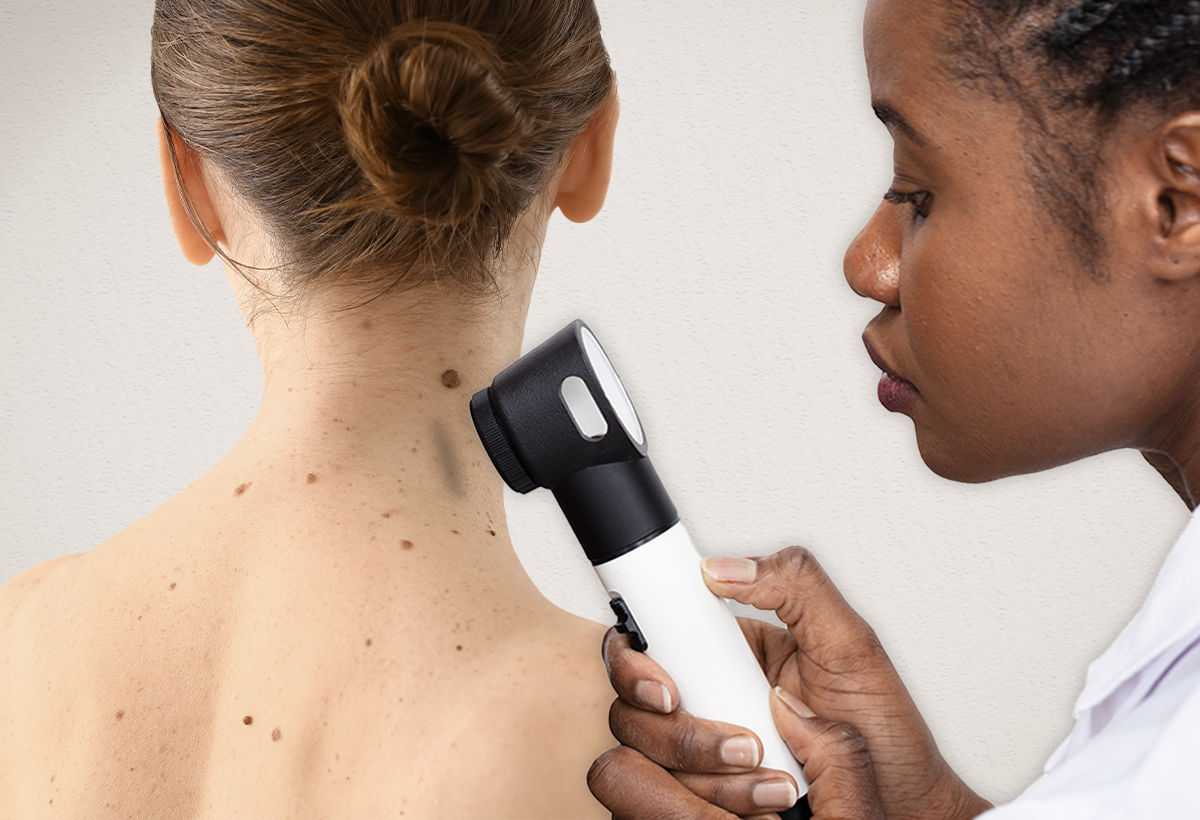basal cell carcinoma