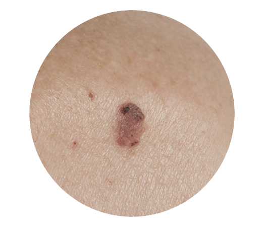Squamous Cell Carcinoma Skin Cancer Screening