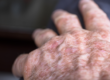 Actinic Keratosis Treatment