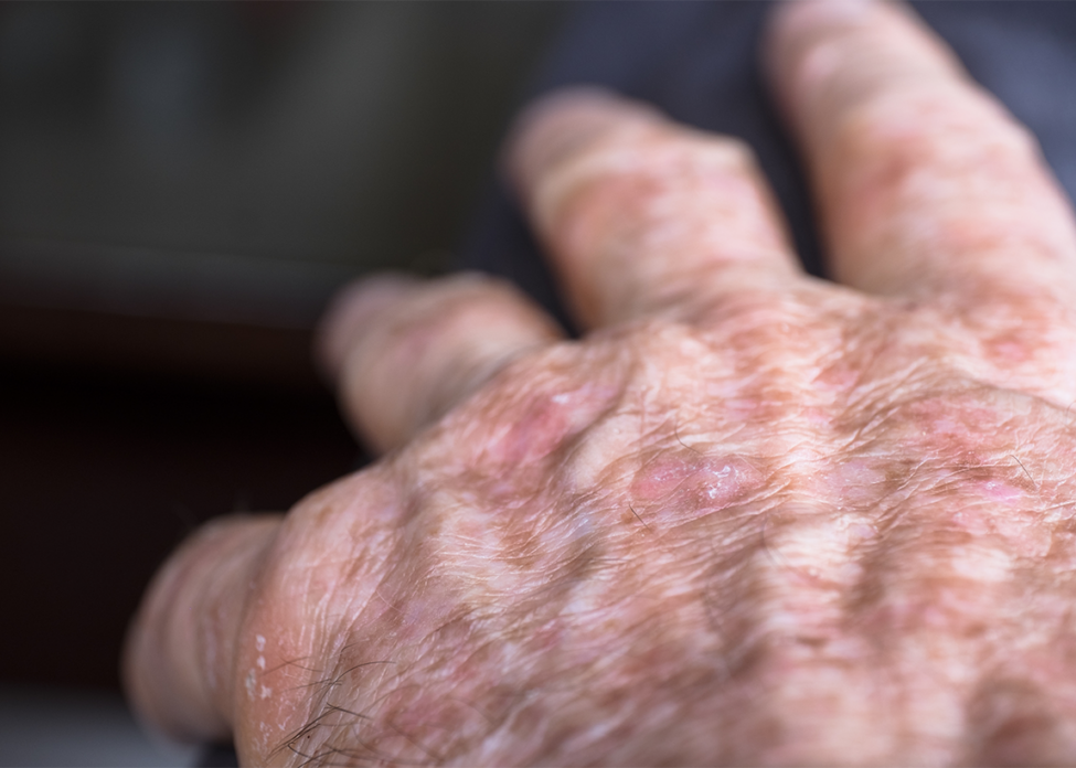 Actinic Keratosis Treatment