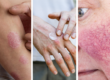 Common skin conditions - Psoriasis, Eczema Rosacea