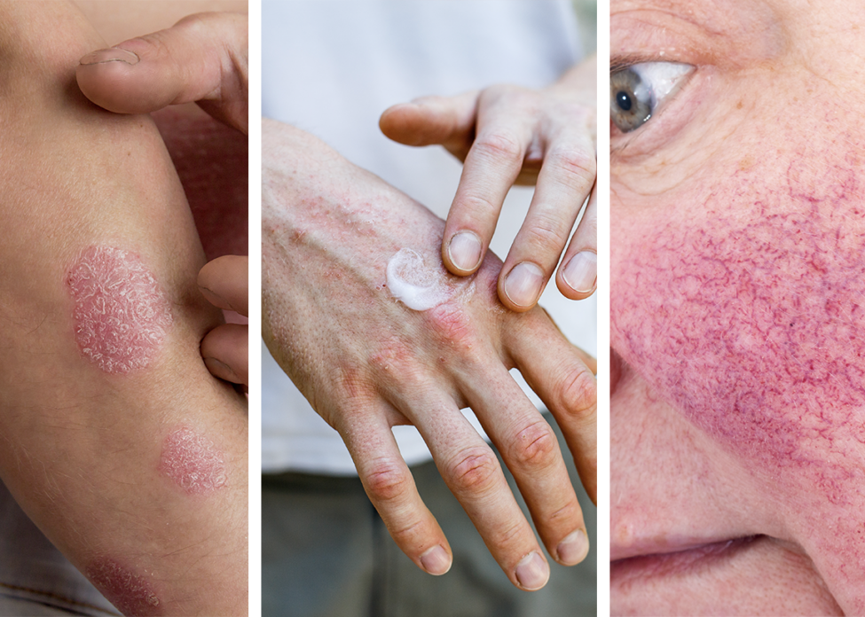Common skin conditions – Psoriasis, Eczema Rosacea Common skin conditions - Psoriasis, Eczema Rosacea