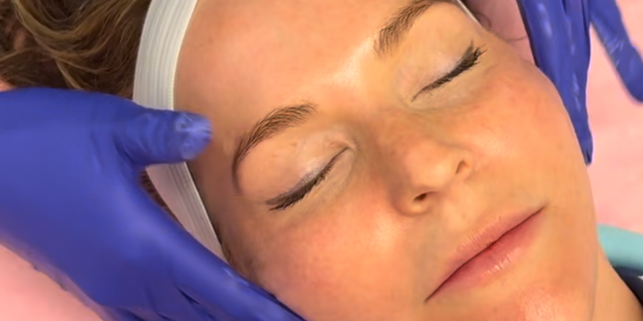 Chemical Peels