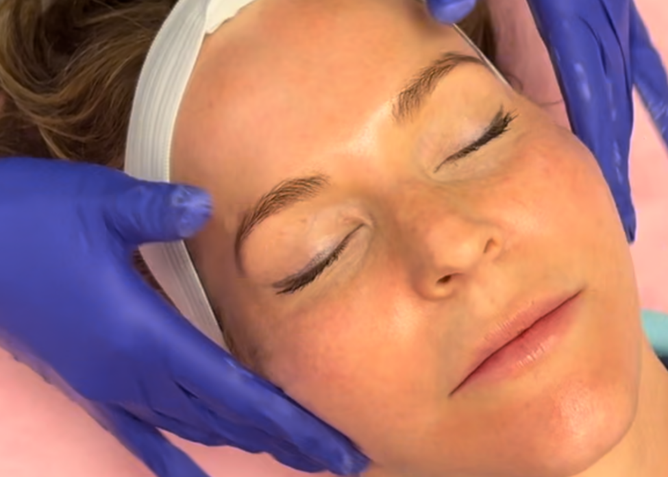 Chemical Peels