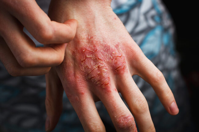 Man Scratch Oneself, Dry Flaky Skin On Hand With Psoriasis Vulga Dry