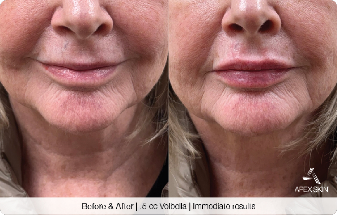 0.5 cc Volbella - Before & After
