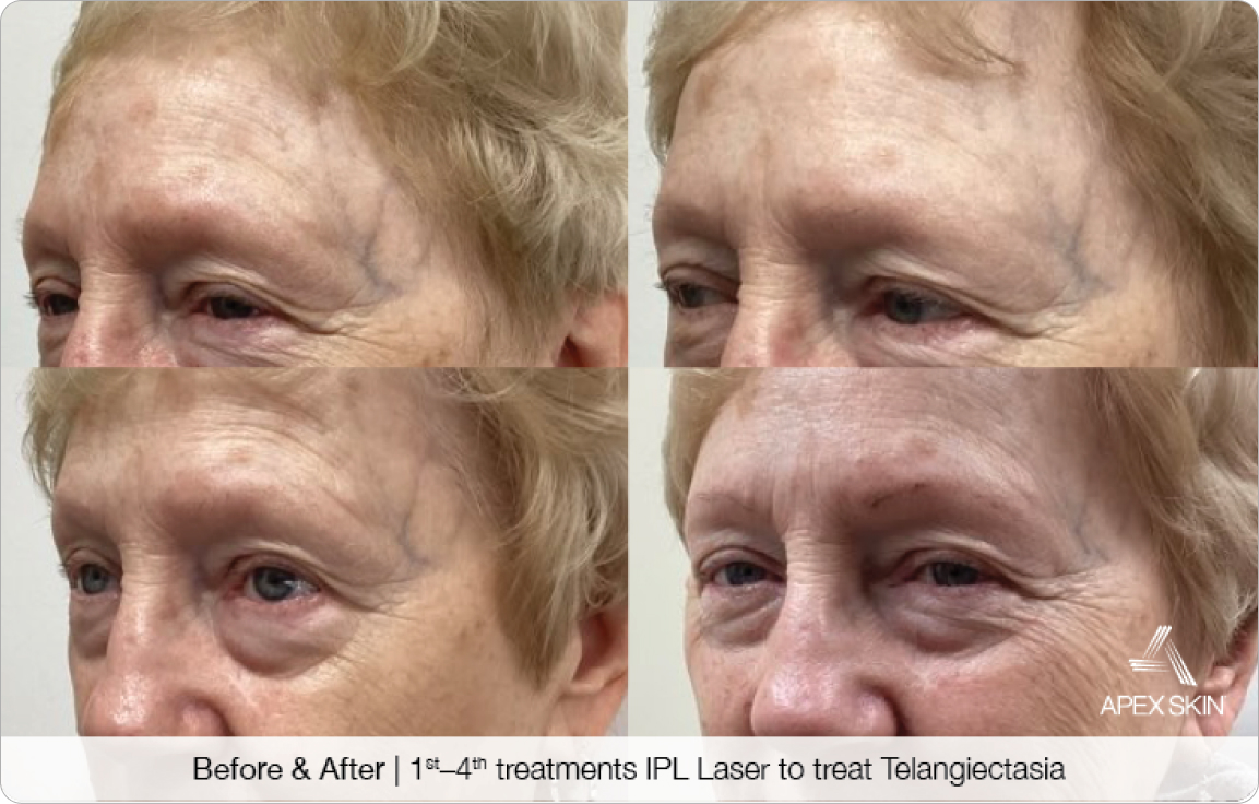 IPL Laser to treat Telangiectasia - Before & After