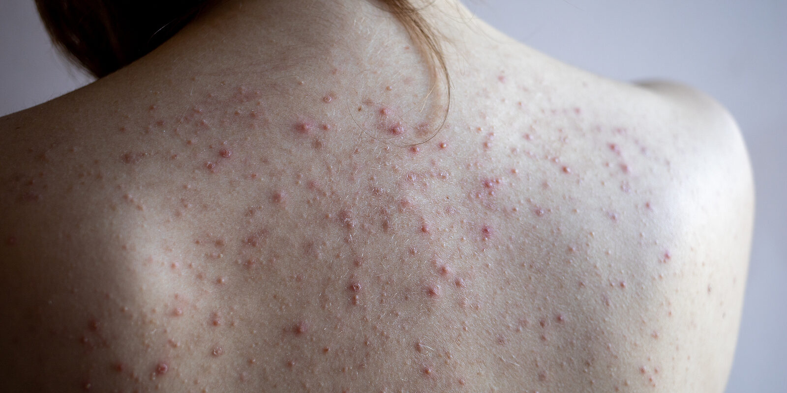 Body acne treatment