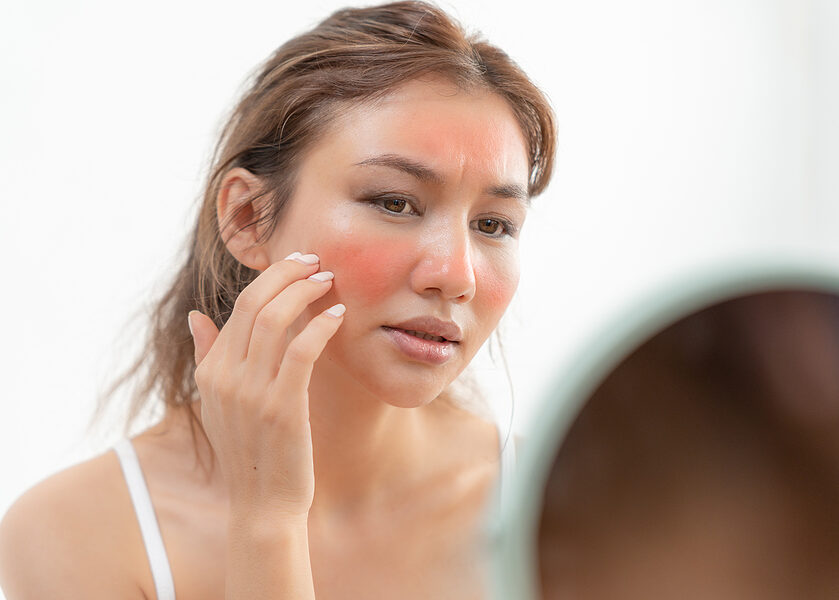 Young Woman Are Worried About Faces Dermatology And Allergic To Post-Sun Recovery