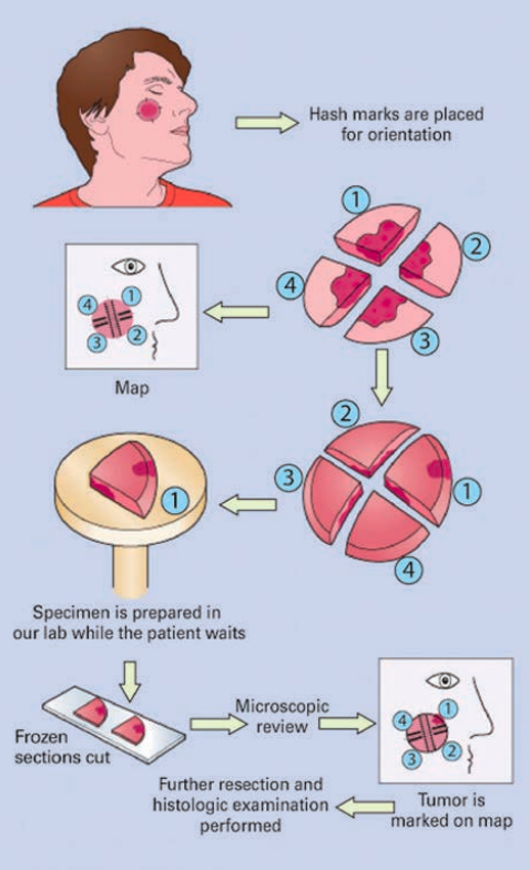 Skin cancer