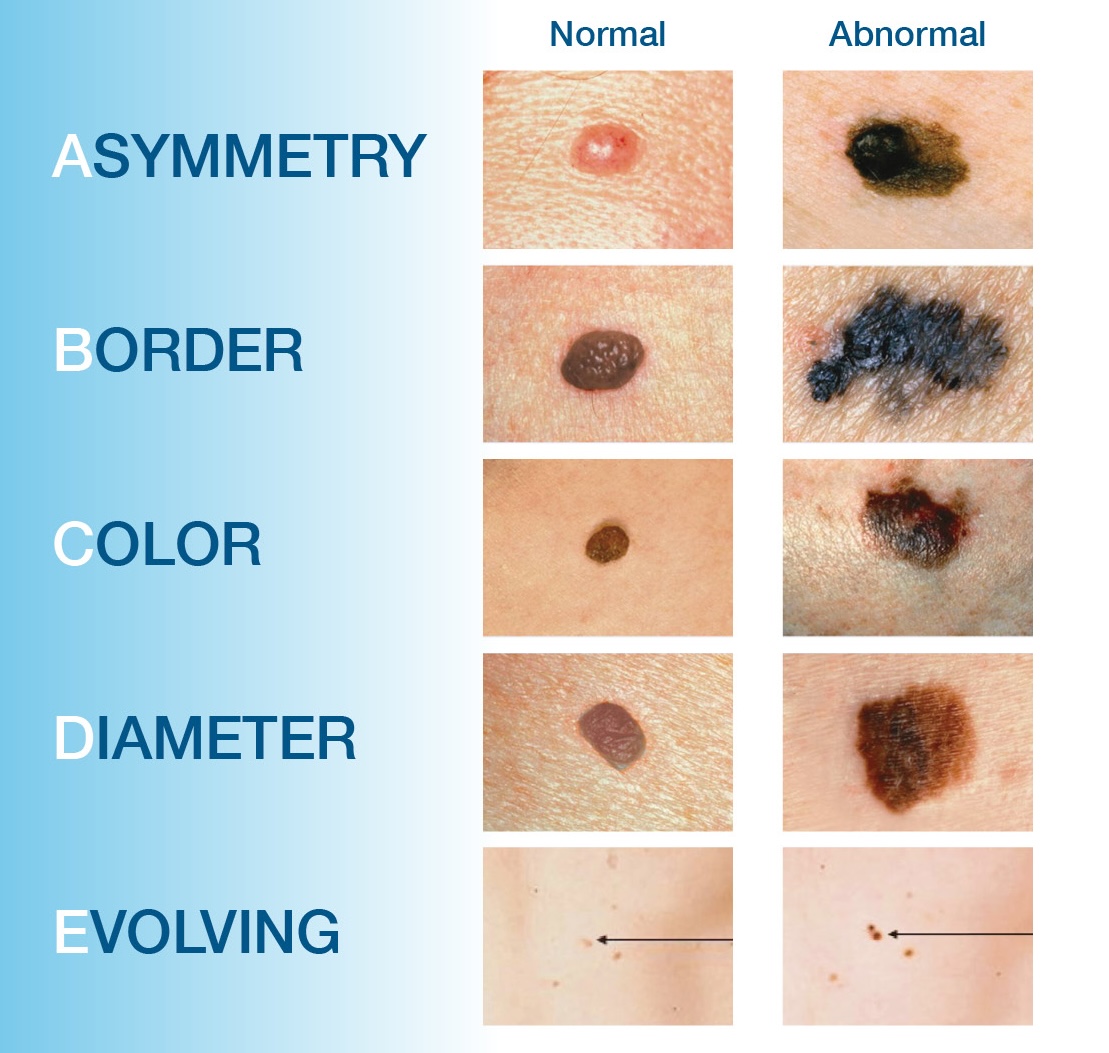 Graphic showing the signs of skin cancer.