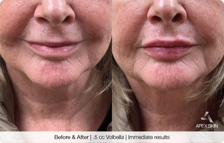 Before & After - .5cc Volbella